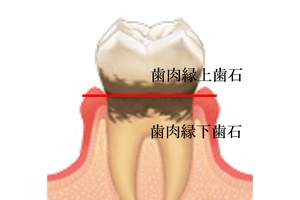 歯石