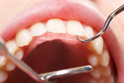 麻布十番歯科で口内の検診を受けているイメージ