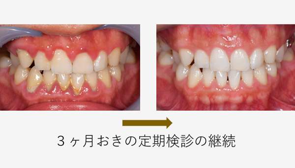 麻布十番歯科で3ヶ月おきに定期検診を受けた場合の症例写真