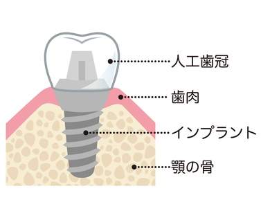 麻布十番歯科のインプラント治療をイメージした断面図