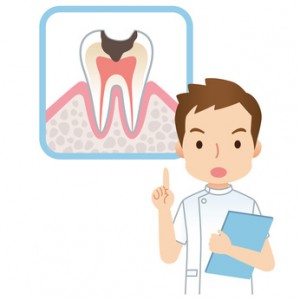 虫歯にも程度がある