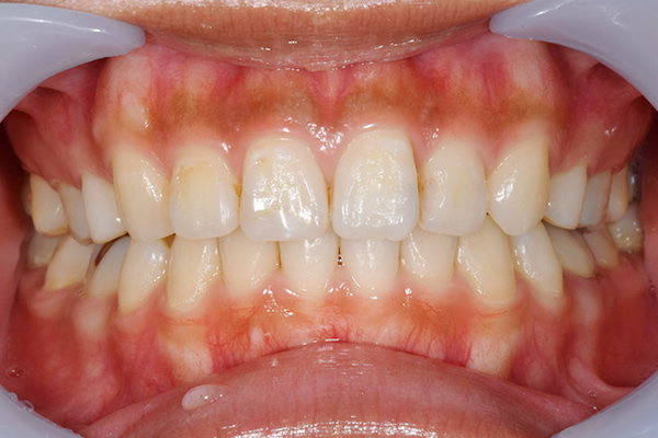 歯茎ピーリング:施術前