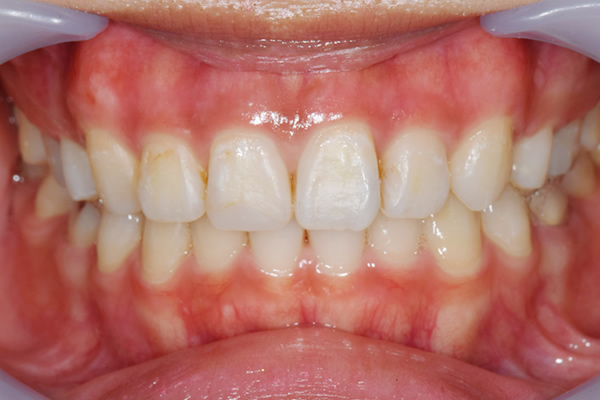 歯茎ピーリング:施術後