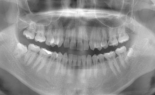 麻布十番歯科で歯石除去を行っているイメージ