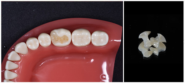 セラミックのつめ物