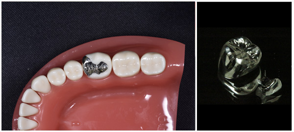 バラジウム（銀の金属）のつめ物