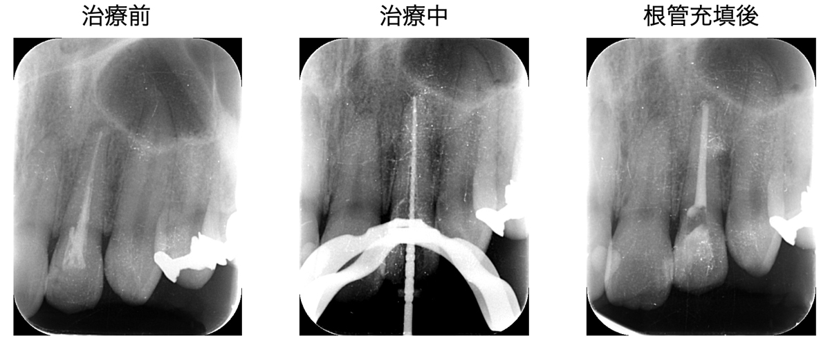 感染根管治療の症例写真