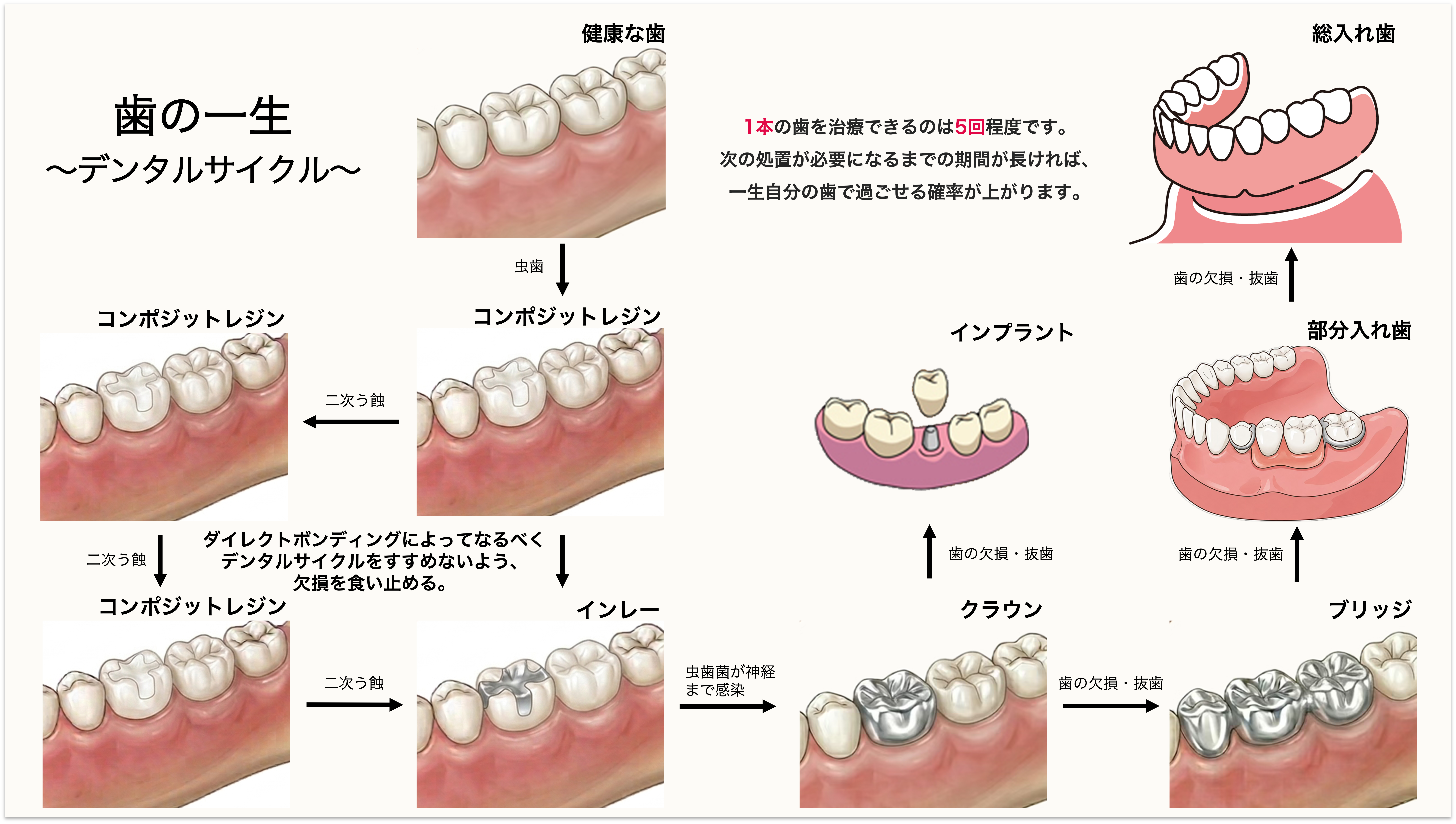 当院のダイレクトボンディングのこだわり