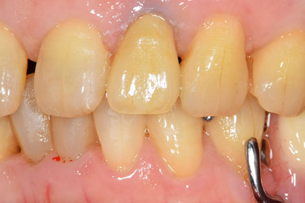 治療後：保険適応の前歯のかぶせ物をオールセラミック　スタンダードにて修復