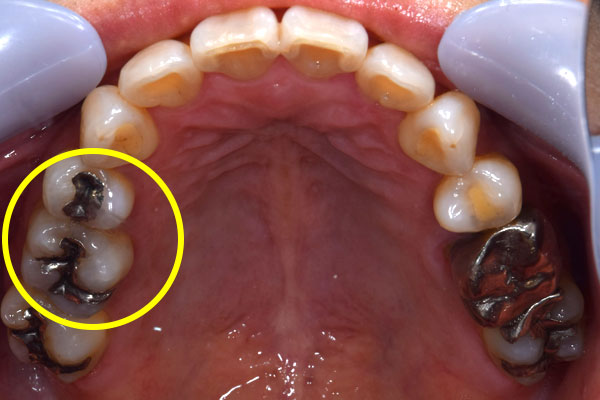 治療前：銀歯をハイブリットセラミックインレーに変える