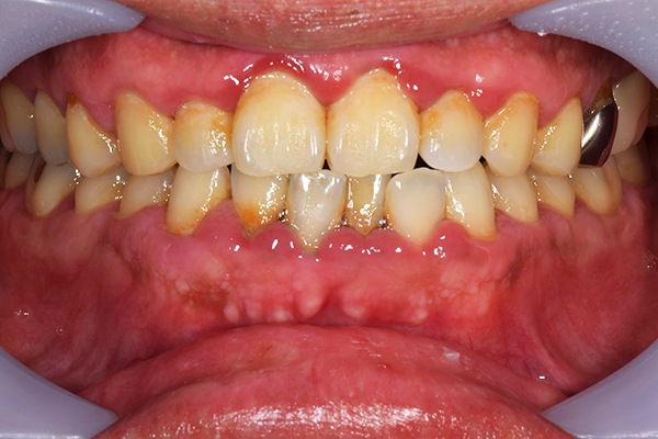 治療前：初期歯周病治療