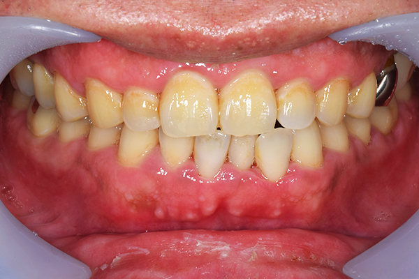 治療後：初期歯周病治療