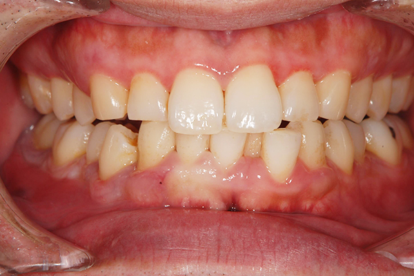 治療後：
初期〜中等度歯周病治療