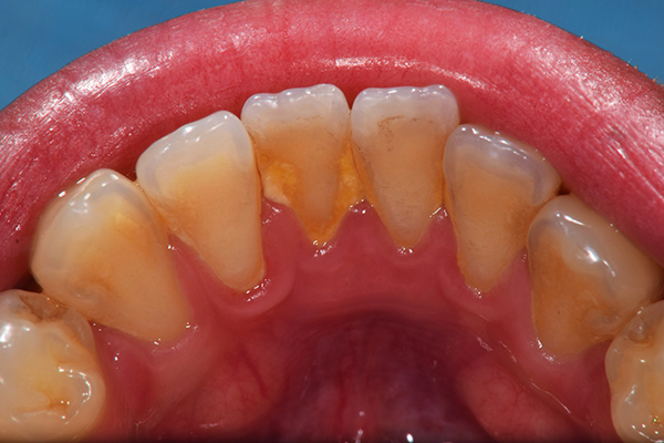 治療前：
初期〜中等度歯周病治療