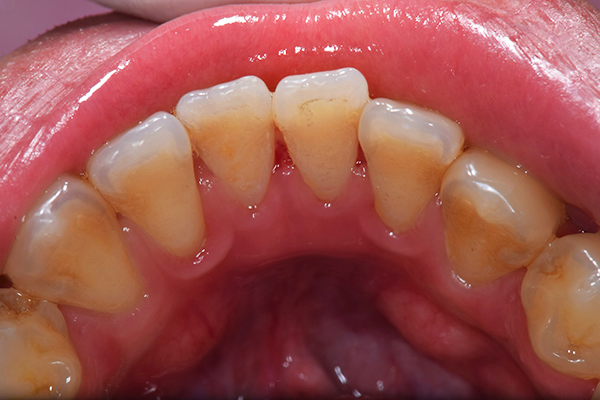 治療後：
初期〜中等度歯周病治療