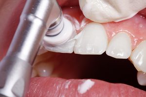 定期的な歯医者への受診