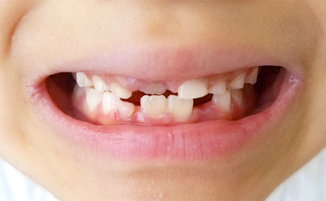 小児の虫歯治療
