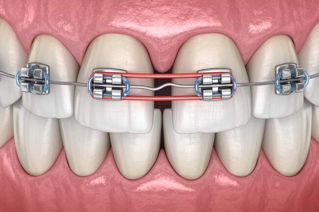 すきっ歯の歯列矯正