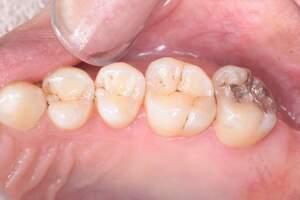 歯石除去（SC）