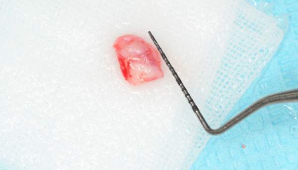 歯肉移植の種類